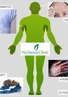 Diagram showing body areas for fungal infection treatment at NoSweat Clinic.